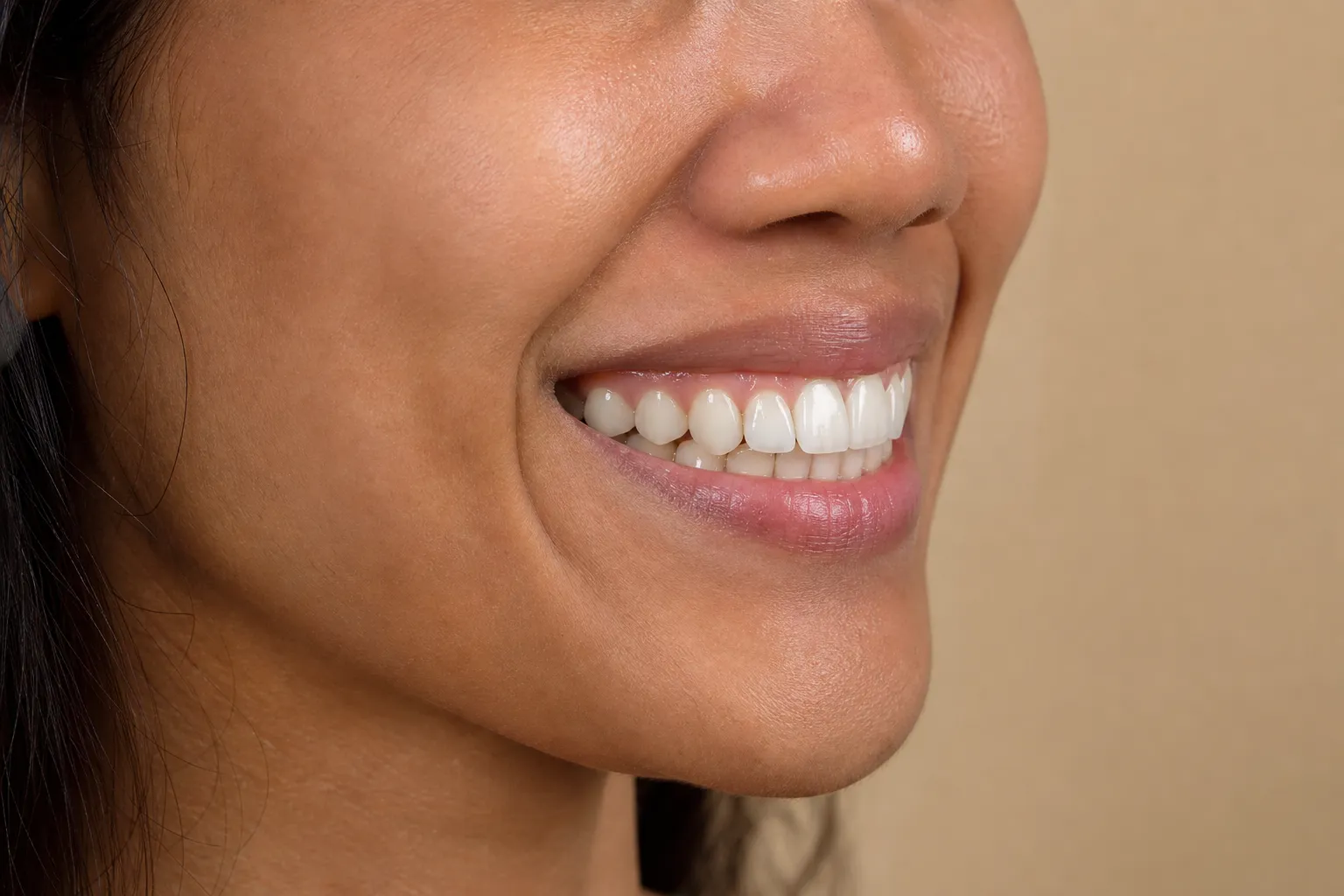 Patient's smile from a three-quarter angle after veneer treatment